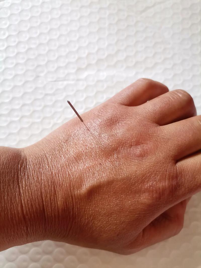 三焦不通针灸几天能见效果