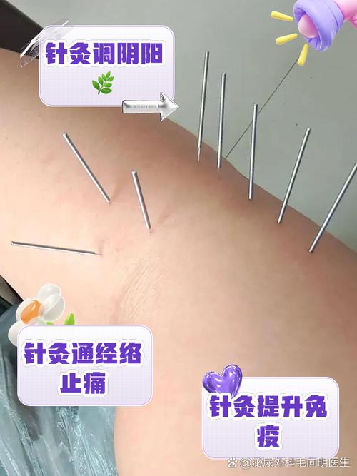 针灸可以治疗腰间盘突出吗