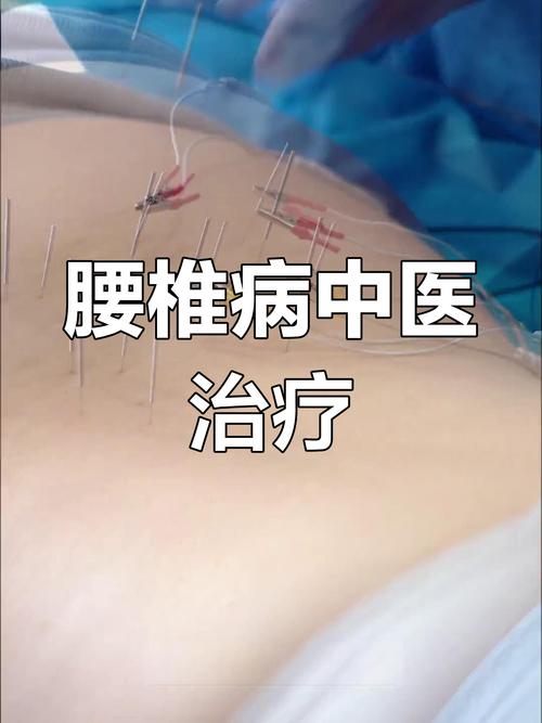 腰间盘突出针灸多长时间