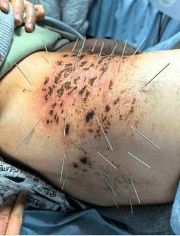 针灸治疗带状疱疹后遗症