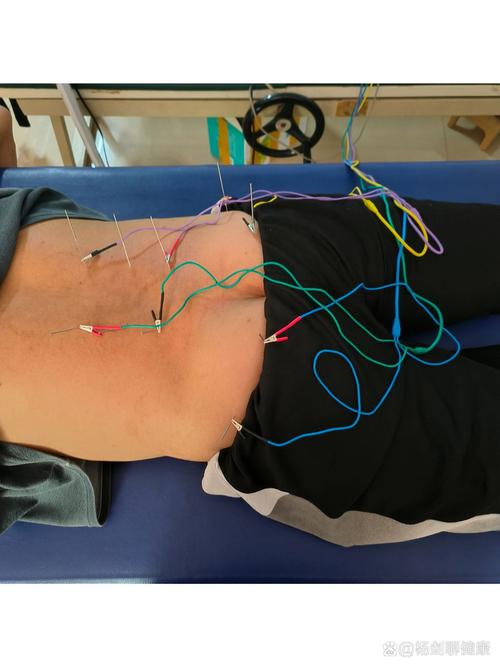 针灸腰椎间盘突出特效穴