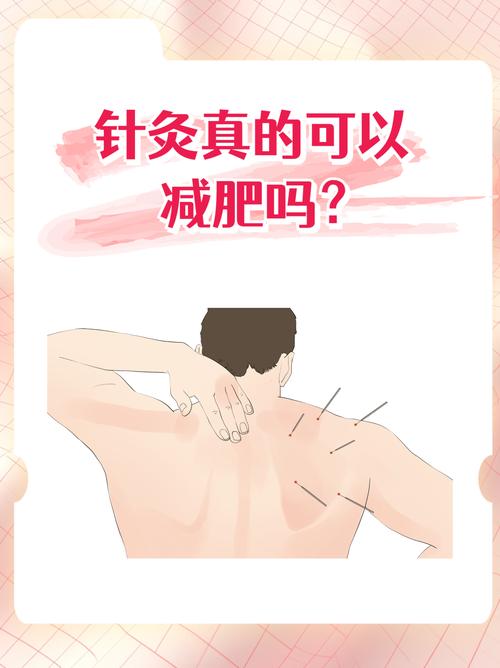 针灸减肥需要控制饮食吗