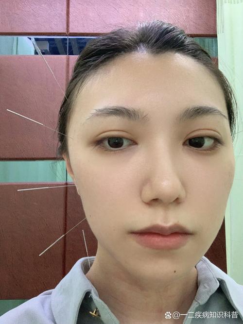 针灸治疗颞下颌关节紊乱