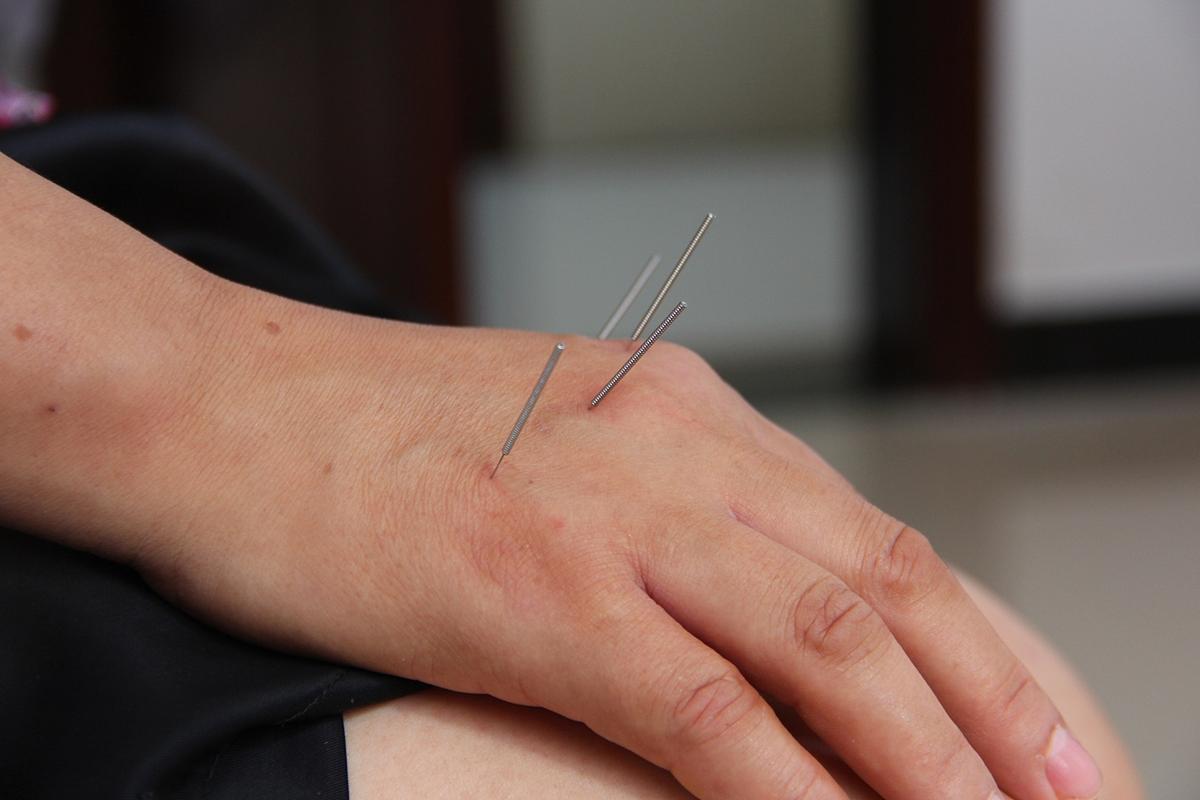 风湿性关节炎可以针灸吗