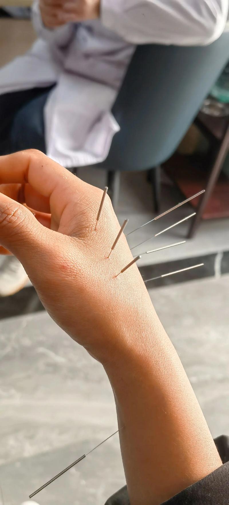 风湿性关节炎可以针灸吗