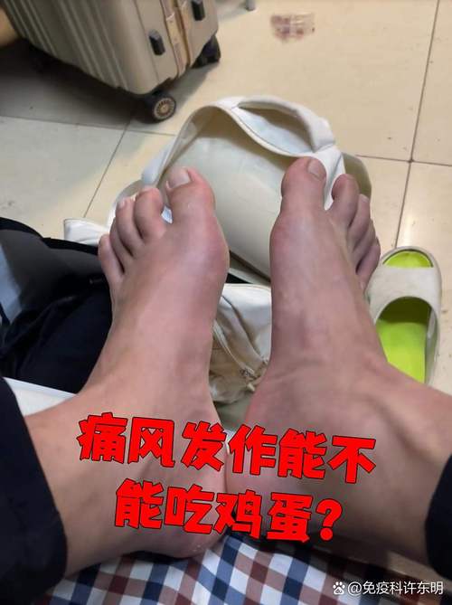 痛风发作期间可以吃鸡蛋吗