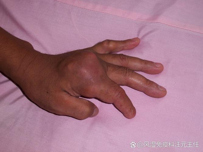 痛风的初期症状有哪些症状