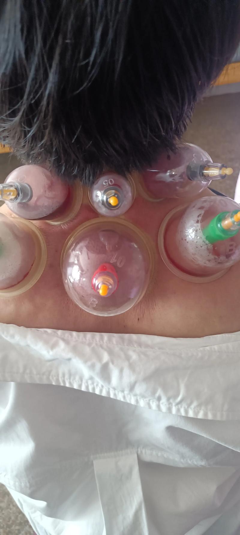 按摩 刮痧 拔罐和针灸