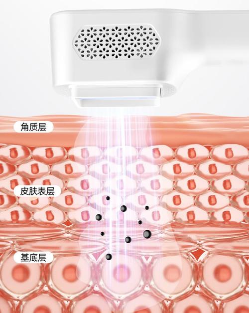 窄谱uvb光疗治白癜风安全吗