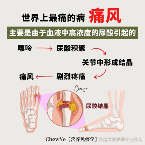 痛风主要有那些临床表现