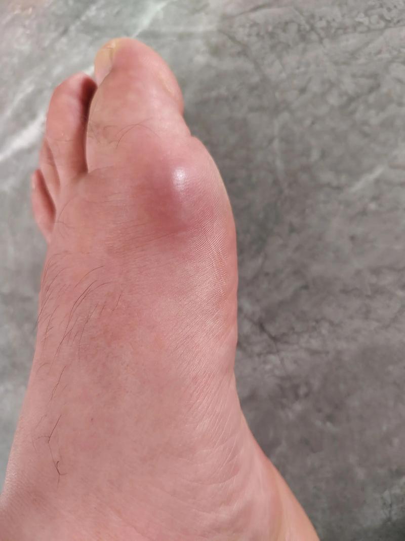 20岁男的痛风多久能好