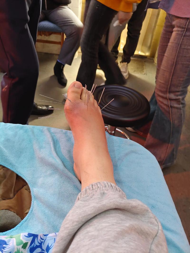 风湿性关节炎的针灸治疗