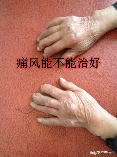 急性痛风关节炎多久能好