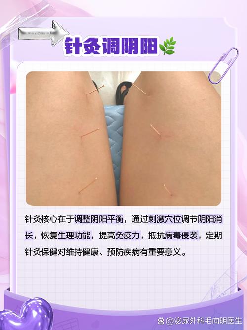 针灸能治植物神经紊乱吗