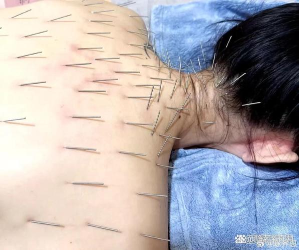 针灸可以治疗静脉曲张吗