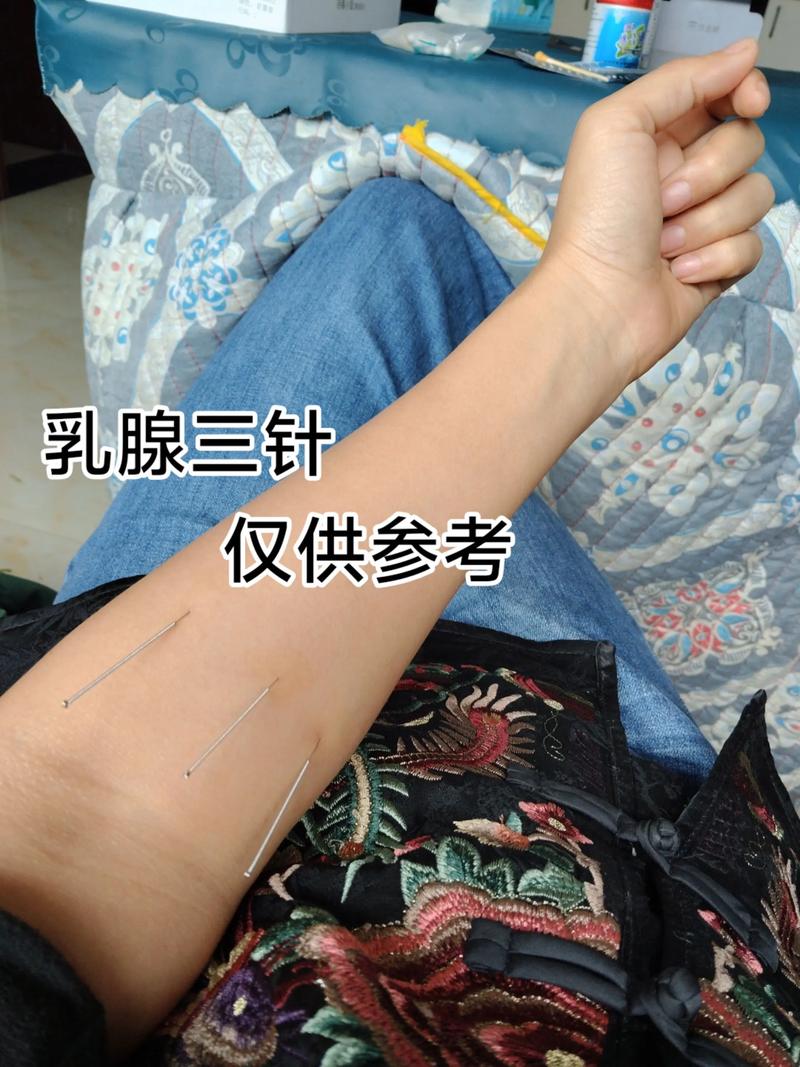 乳腺结节可以针灸治疗吗