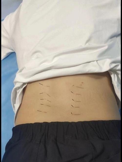 针灸治疗腰椎间盘突出症