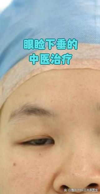眼睑下垂针灸治疗方法