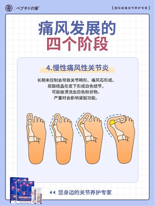 痛风症状发作时间通常是