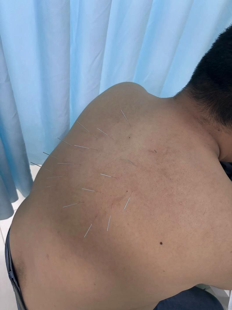 真人背部针灸图片大全