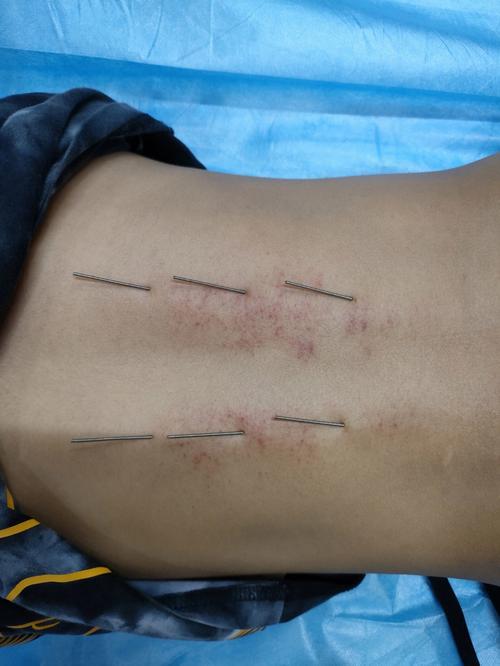 真人背部针灸图片大全