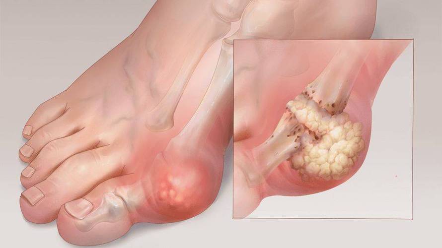 痛风可以跑1000米吗