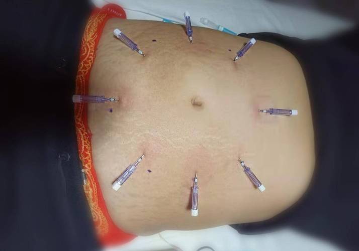 针灸治疗腹部胀气视频