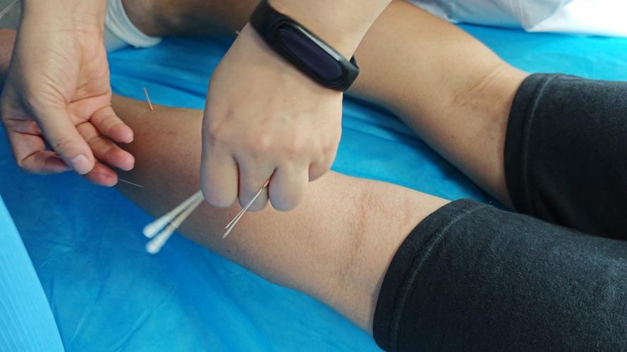 腿部肌肉萎缩针灸治疗