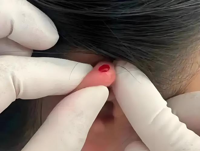 针灸耳朵放血治疗痘痘