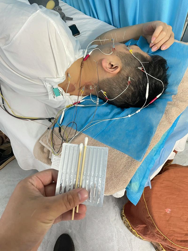 针灸治疗脑瘫八一优秀