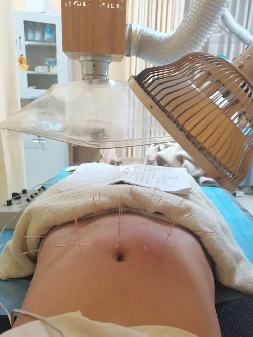 针灸治疗脾胃虚寒效果