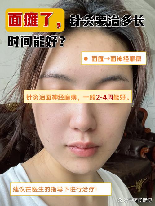 面部神经痉挛针灸好吗