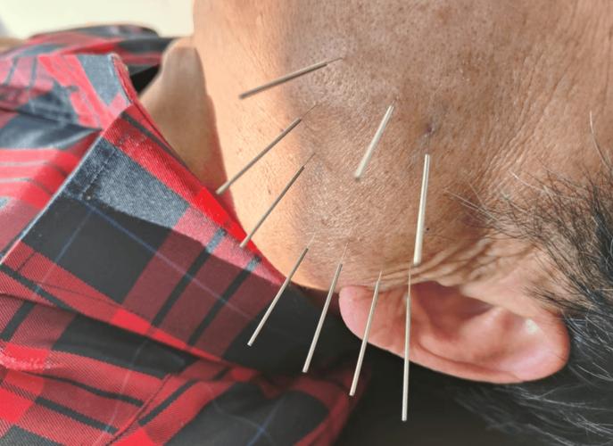 面部神经痉挛针灸好吗