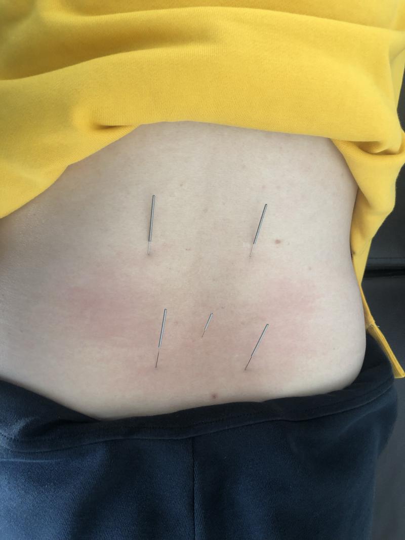 腰肌劳损针灸效果好吗