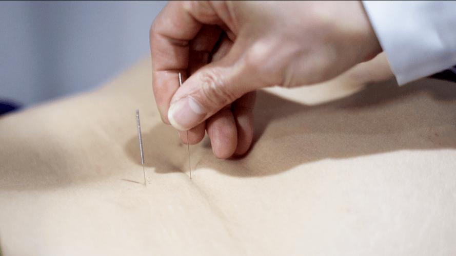 上海哪家医院可以针灸