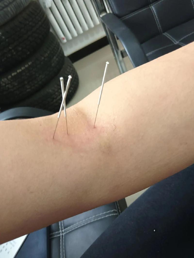 慢性咽炎针灸效果好吗