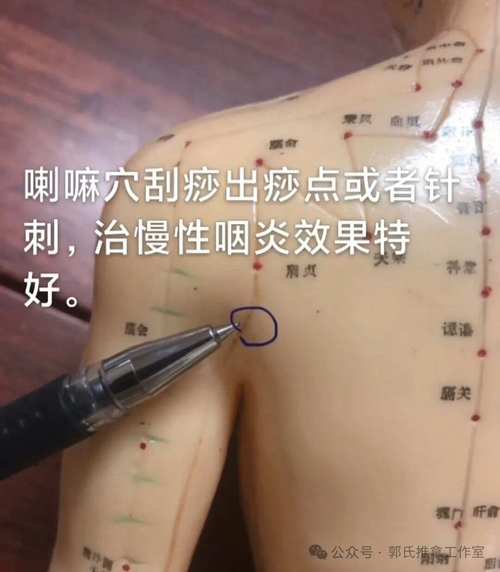 慢性咽炎针灸效果好吗