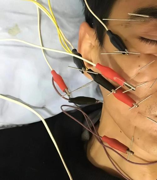 面部痉挛针灸多久会好