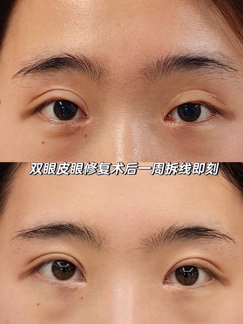 双眼皮失败修复手术安全吗