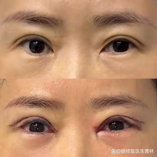 双眼皮失败修复手术安全吗