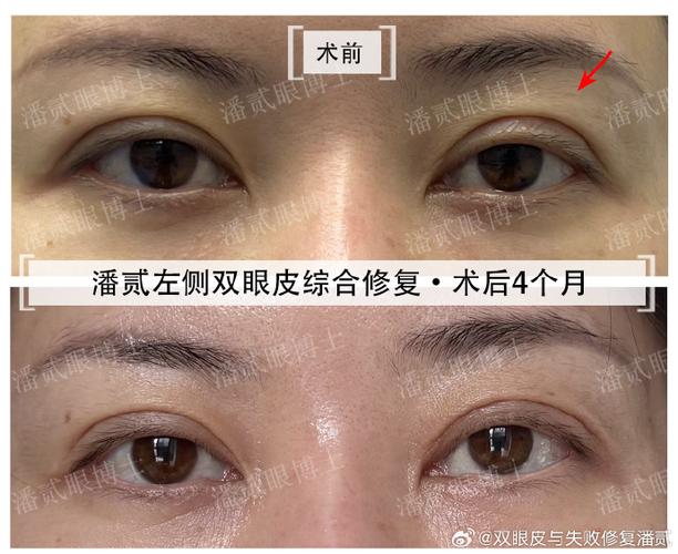 双眼皮失败修复手术安全吗
