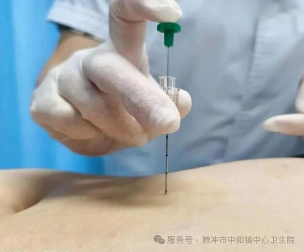 哪些医院可以针灸减肥