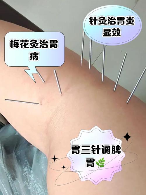 针灸多久可以治好胃病