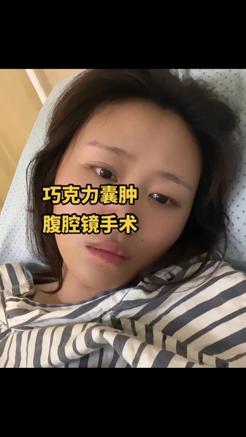 巧克力囊肿可以针灸吗