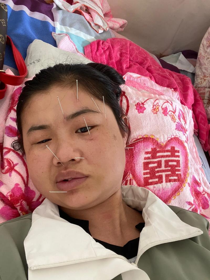 面瘫针灸期间出现联动