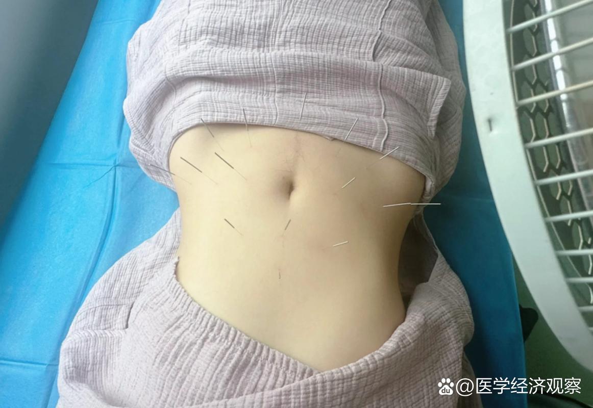 南宁哪里可以针灸减肥