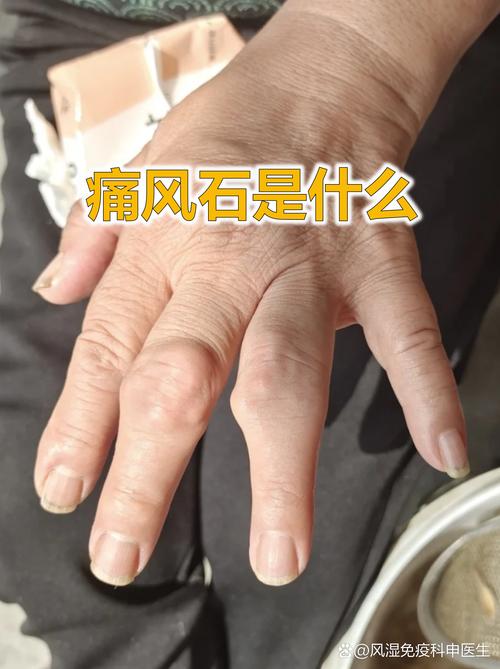 痛风膝盖长痛风石咋办