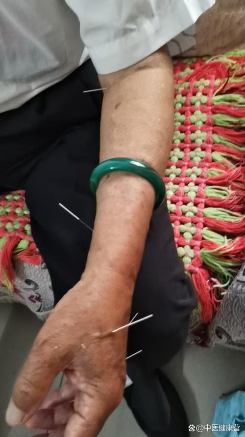 电子针灸可以治疗肾虚