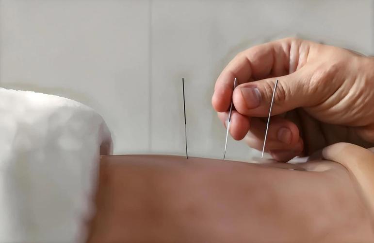 南宁哪里可以学习针灸