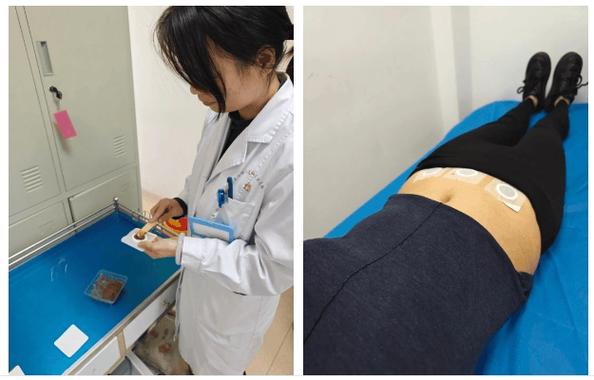 艾灸针灸治疗子宫肌瘤